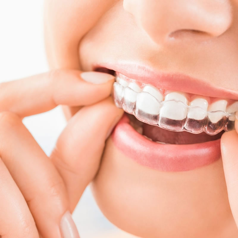 Invisalign – Invisible Braces Modern Dentistry Richmond